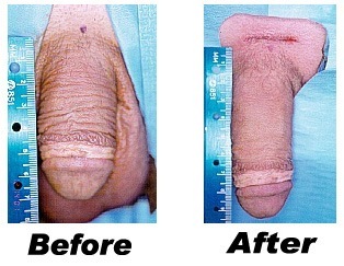 Penis Enlargment Surgery Before And After 36